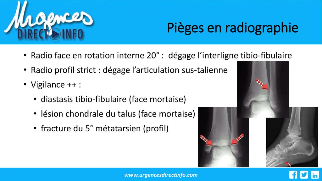 TRAUMATISME DE LA CHEVILLE AUX URGENCES ppt t l charger